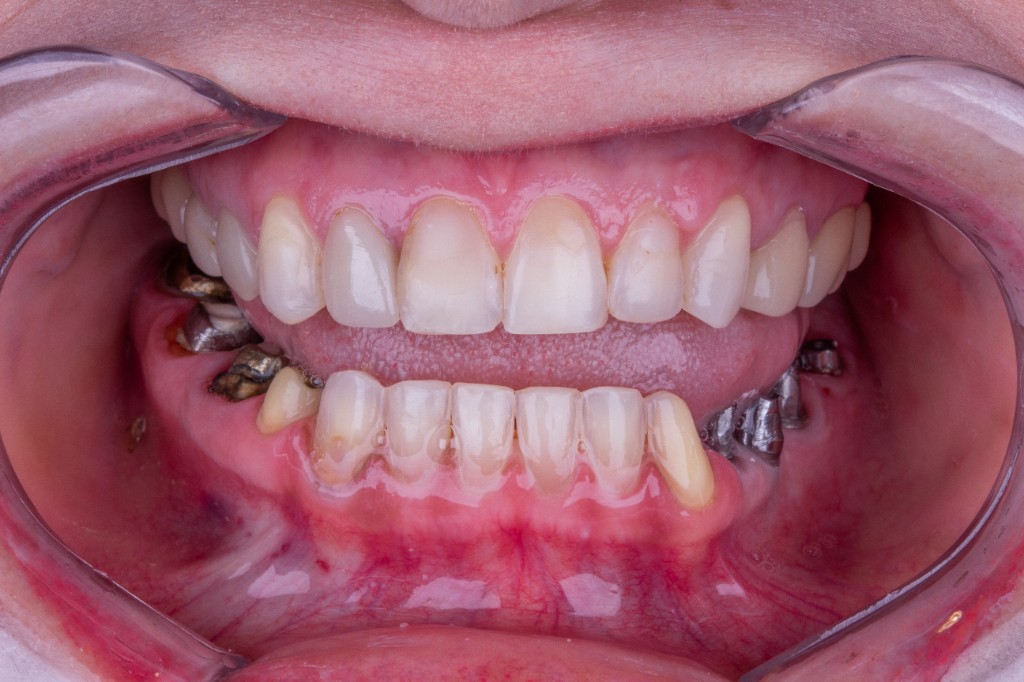 Reabilitação com implantes dentários