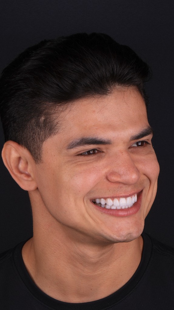 Lentes de contato dental