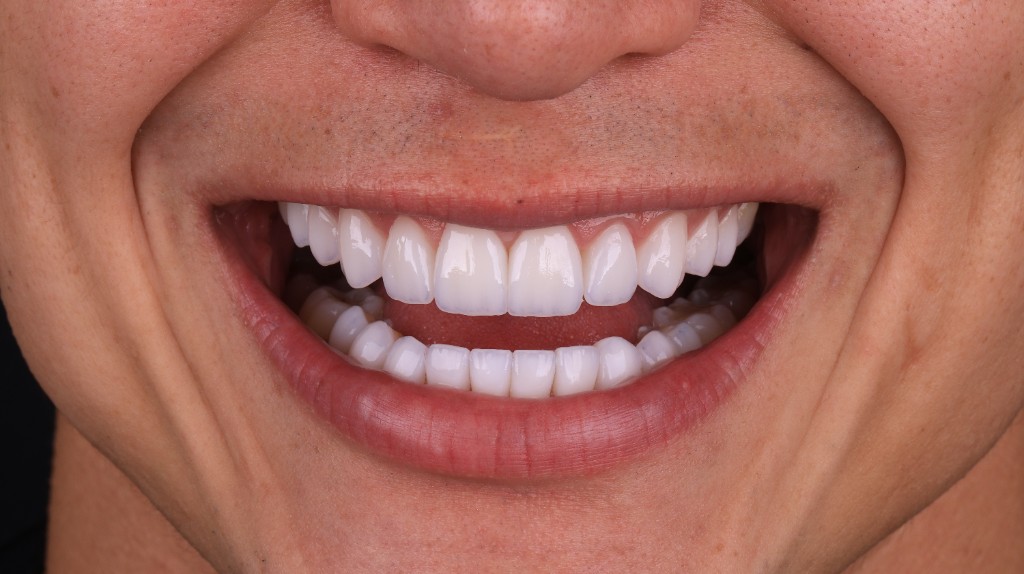 Estética dental com lentes